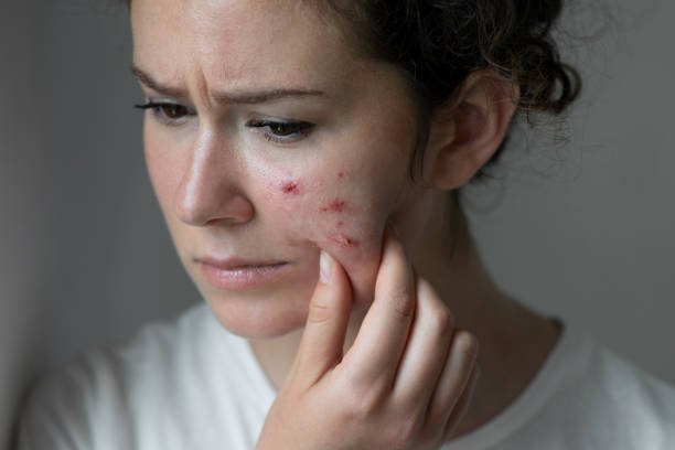 How Pimples Treatment Can Improve Daily Skin Confidence